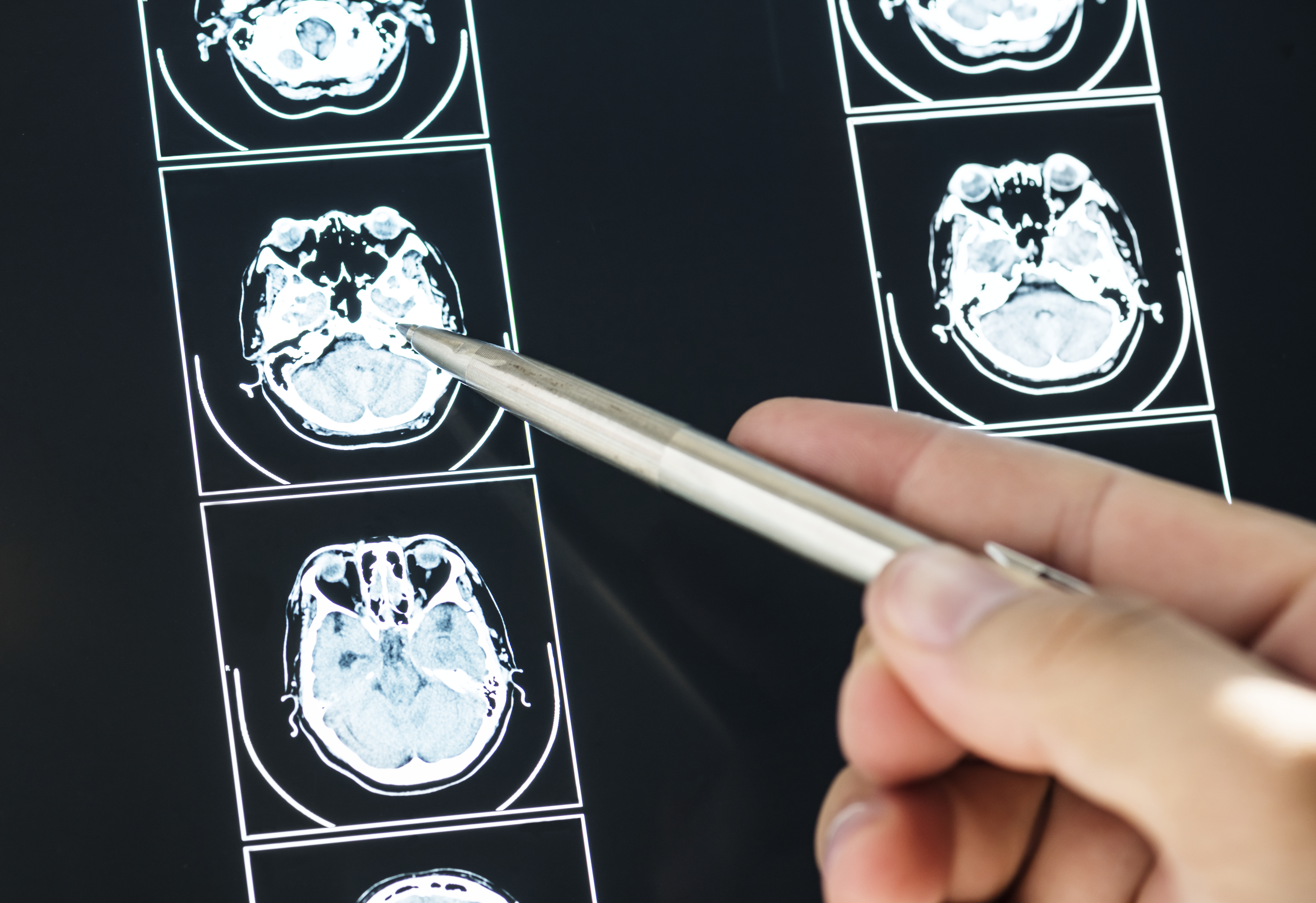 closeup-of-brain-mri-scan-result-2021-08-26-23-57-27-utc